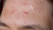 acne acne