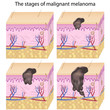 Skin cancer, eps8