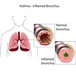 asthma