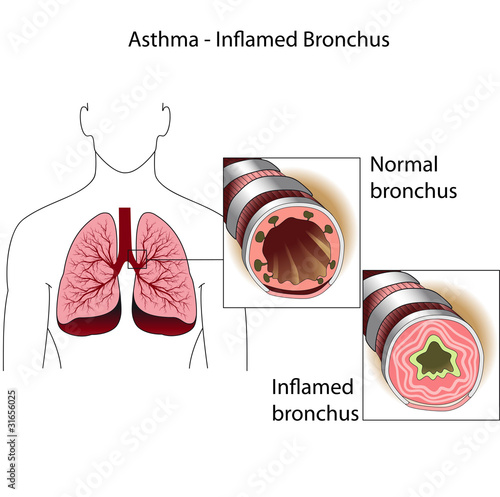 Vector: asthma asthma