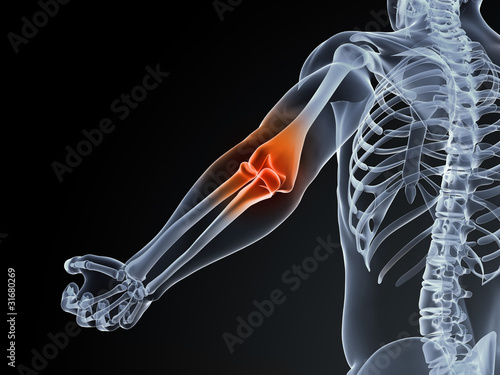 Illustration: 3d rendered medical illustration of an elbow bursitis 3d rendered medical illustration of an elbow bursitis