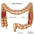 Colon pathologies, eps8