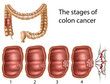 Colon cancer, eps8