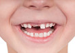 Toothless smile