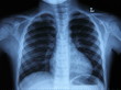 Pulmonary Radiography
