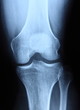 Radiography / Tibia