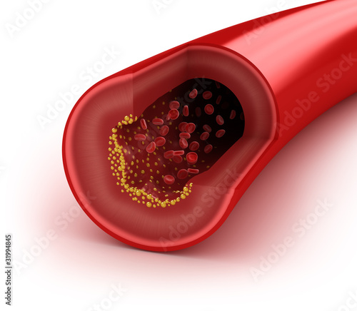 Illustration: Cholesterol plaque in artery, concept isolated on white Cholesterol plaque in artery, concept isolated on white