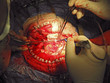 Brain Surgery Brain Surgery