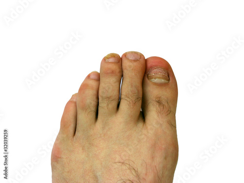 Photo: Toe nail with bruise Toe nail with bruise