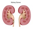 Healthy kidney and kidney with stones, eps8