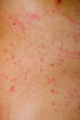 allergic rash dermatitis skin