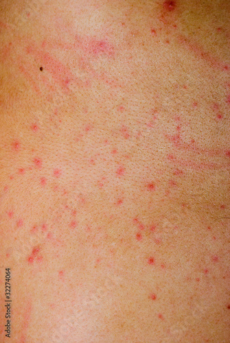 Photo: allergic rash dermatitis skin allergic rash dermatitis skin