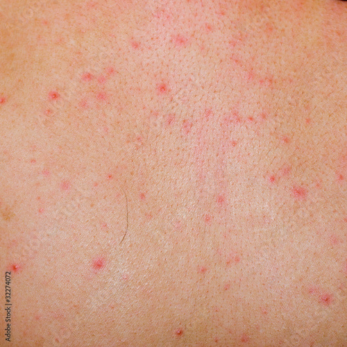 Photo: allergic rash dermatitis skin allergic rash dermatitis skin