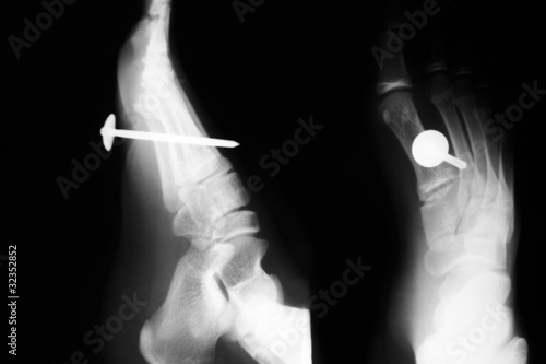 Photo: Foot X ray Foot X ray