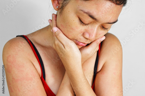 Photo: Adult woman with skin allergy rash Adult woman with skin allergy rash