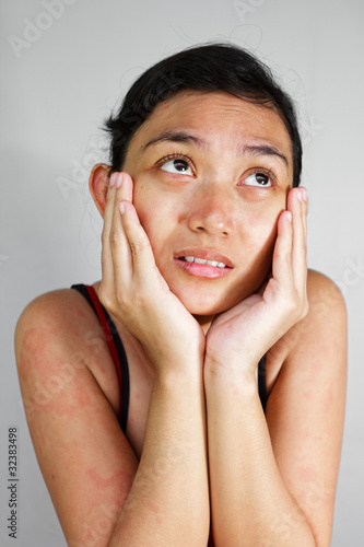 Photo: Sad woman with skin rash Sad woman with skin rash