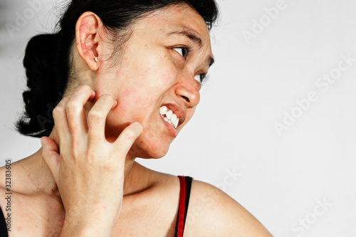 Photo: Woman scratch face with skin rash Woman scratch face with skin rash
