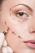 Correction lines on woman face, before surgery operetion Correction lines on woman face, before surgery operetion