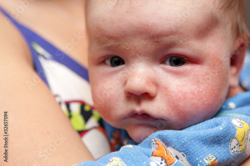 Photo: Eczema on face of newborn Eczema on face of newborn