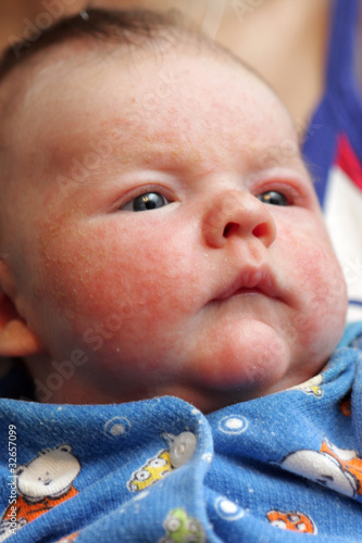 Photo: Child has eczema Child has eczema