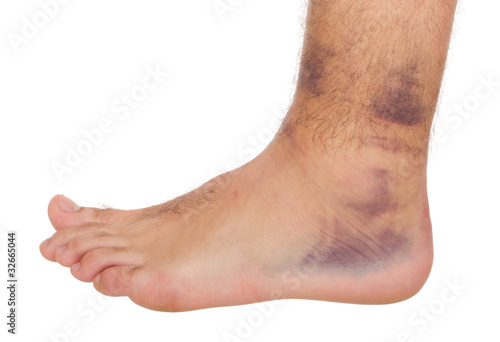 Photo: Ankle Sprain Ankle Sprain