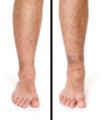 Ankle Sprain