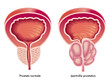 Ipertrofia prostatica