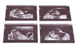 sonogram of Identical (monozygotic) twins