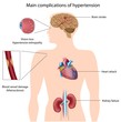 Hypertension complications, eps8