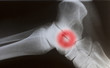 human foot ankle closeup xray with red circle focusing pain
