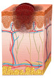 melanoma
