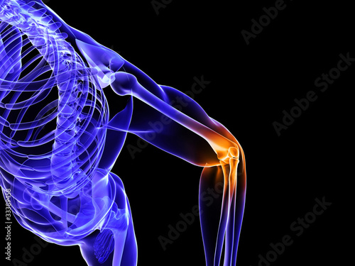 Illustration: 3d rendered medical illustration of a bursitis 3d rendered medical illustration of a bursitis