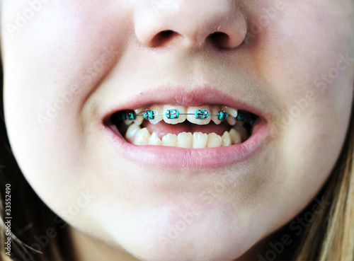 Photo: braces on bad crooked teeth braces on bad crooked teeth