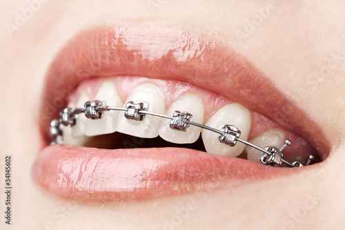 Photo: teeth with braces teeth with braces