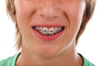 Junge mit Zahnspange