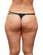 cellulite buttocks