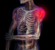 X-ray illustration of shoulder pain.