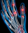Arthritis 4