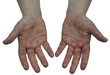 Hand, Foot and Mouth Disease 1