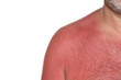 Sonnenbrand