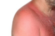 Foto: Sonnenbrand Sonnenbrand
