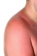 Foto: Sonnenbrand Sonnenbrand