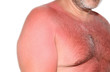Sonnenbrand