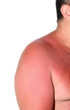 Sonnenbrand
