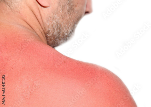Photo: Sonnenbrand Sonnenbrand