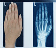 x-ray picture left hand
