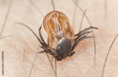 Photo: Tick feeding on human, extreme close up Tick feeding on human, extreme close up
