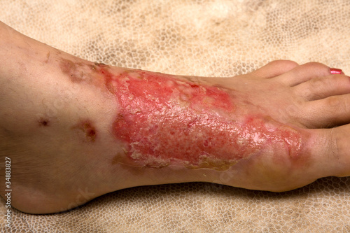 Photo: Severe burns in the women Severe burns in the women