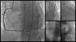 Cardiac Catheterization Mosaic Cardiac Catheterization Mosaic