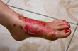 Burn feet